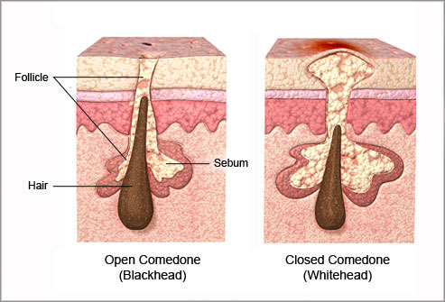 Verzadigen houding blik Behandelingen tegen acne, wat is een geschikte behandeling?